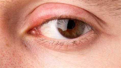 kirminas, atsirandantis dėl žmogaus akių simptomų